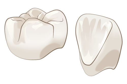 オールセラミック