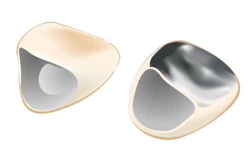 硬質レジン前装冠