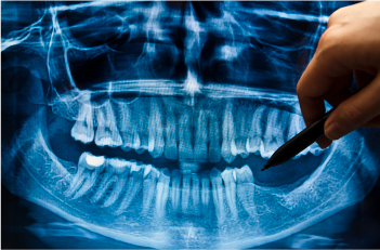 歯ぐきの精密検査