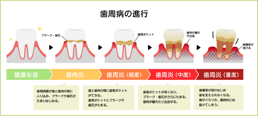 歯周病の原因