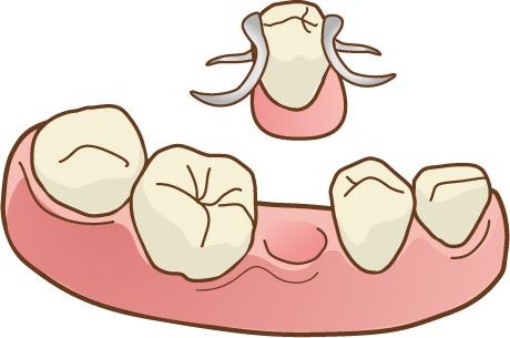 部分入れ歯