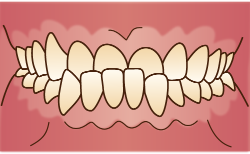 下顎前突（かがくぜんとつ）