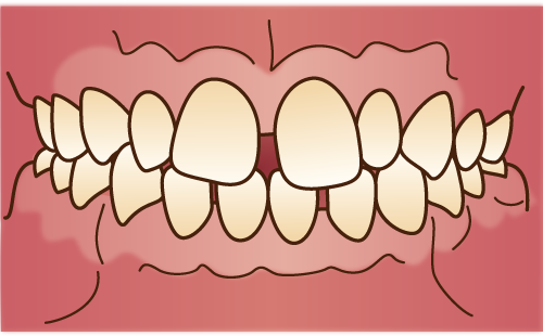 空隙歯列（くうげきしれつ）