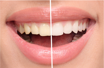 スケーリング・PMTC